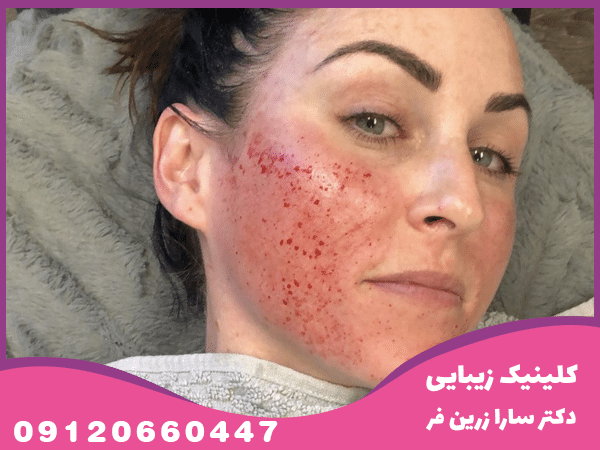 میکرونیدلینگ