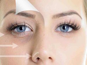 تزریق فیلر برای فرورفتگی زیر چشمی (اشکی)