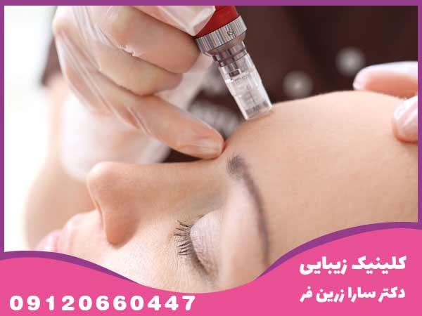 مراحل انجام آموزش میکرونیدلینگ