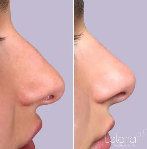 تزریق بوتاکس بینی