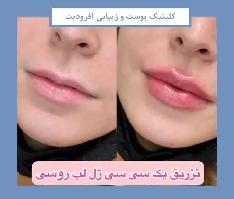 نمونه تزریق ژل لب
