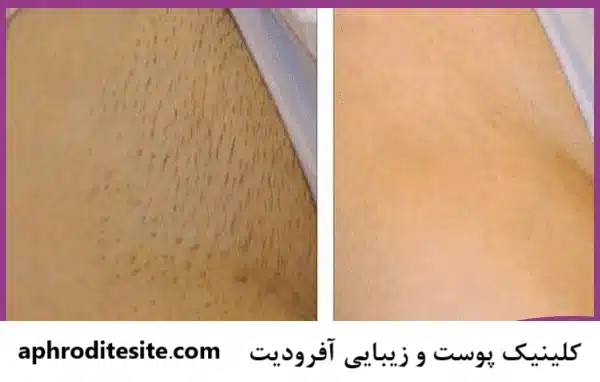 لیزر آلت تناسی بانوان