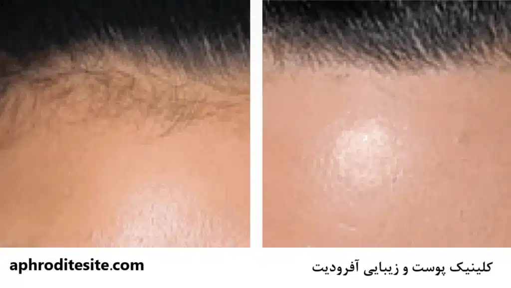 لیزر موهای پیشانی