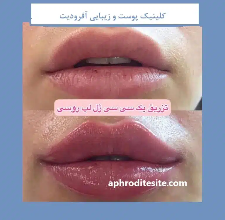 تزریق ژل لب