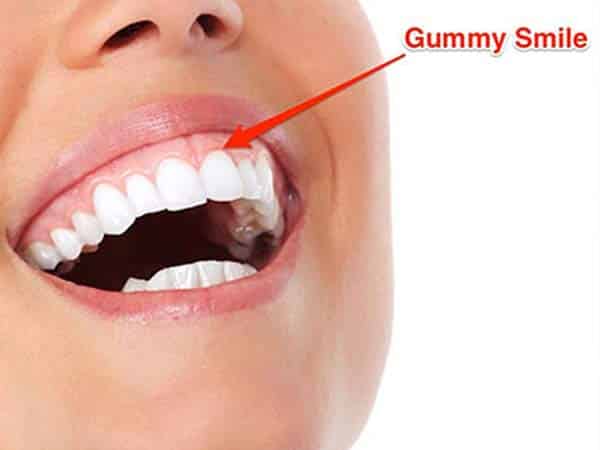 لبخند لثه ای