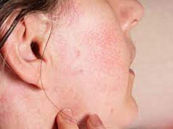 جوش و قرمزی بعد از پاکسازی پوست