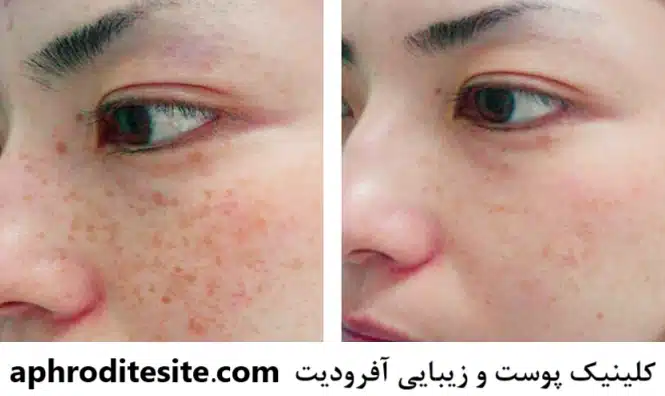 نمونه ای از درمان کک و مک در کلینیک آفرودیت