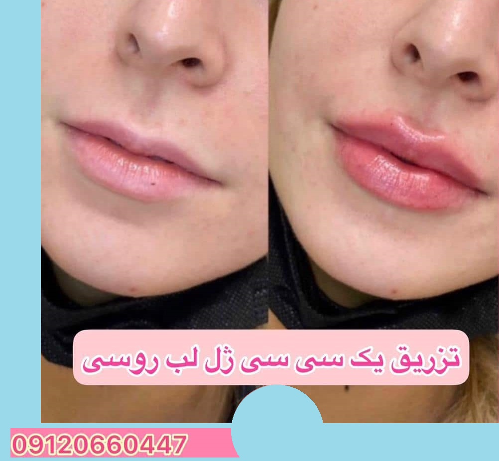 تزریق ژل لب روسی