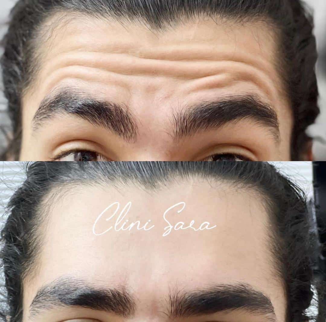 بوتاکس پیشانی
