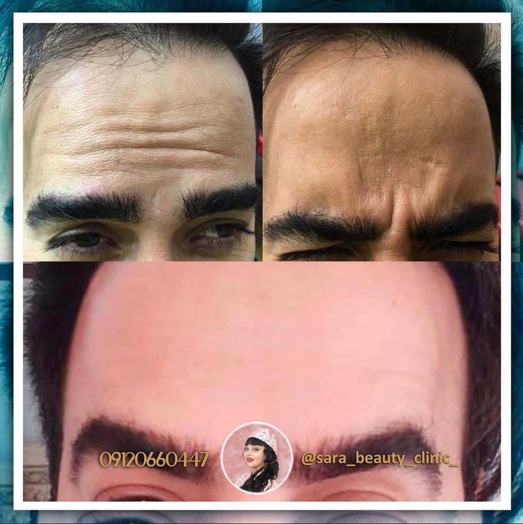 بوتاکس پیشانی