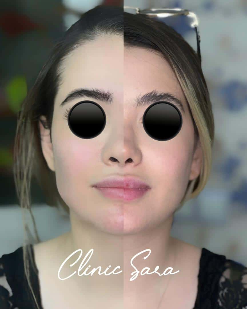 تزریق فیلر