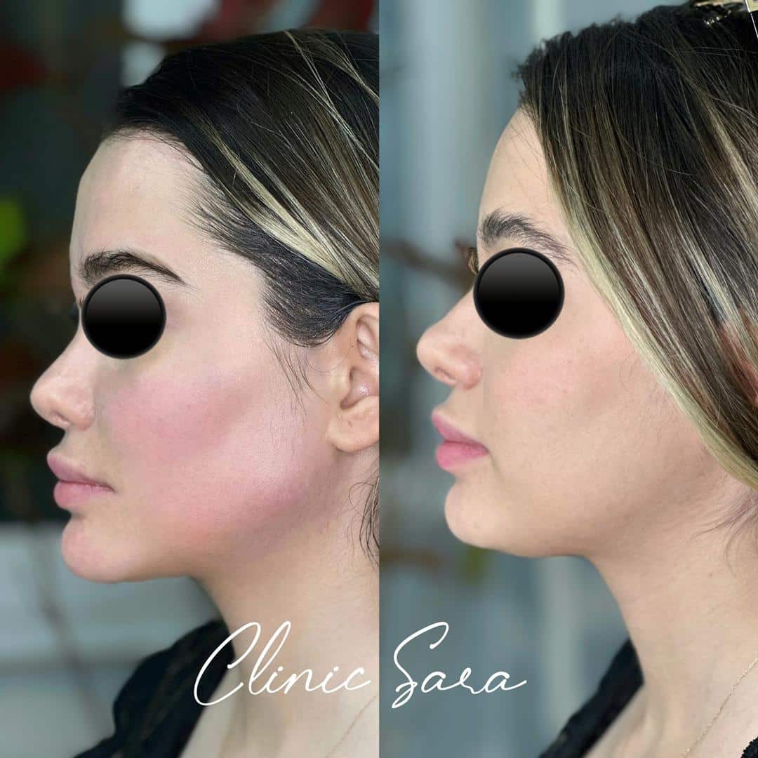 تزریق فیلر چانه