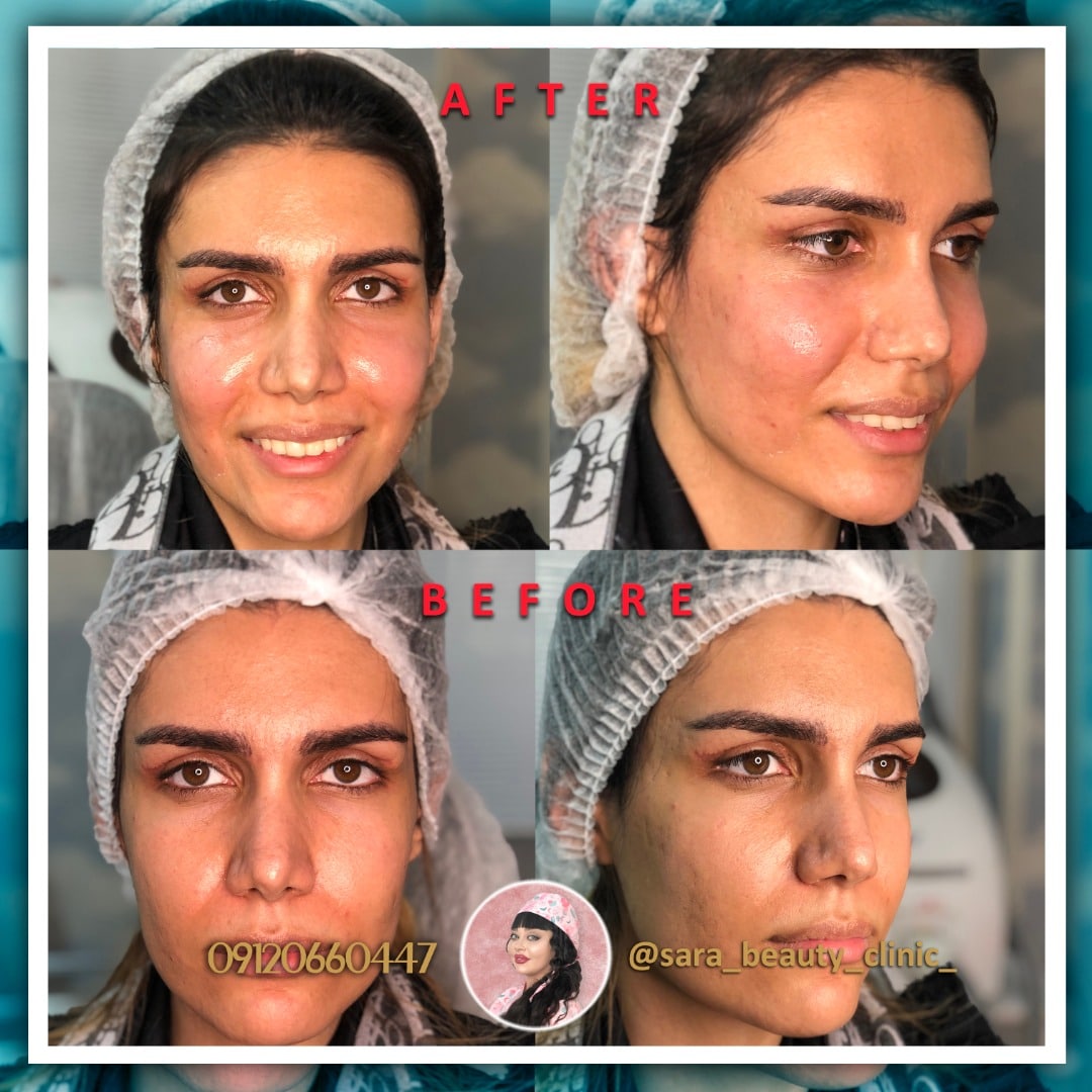 تزریق فیلر گونه